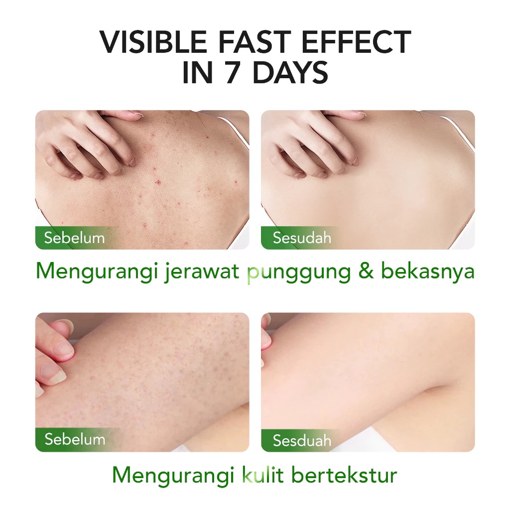 YOU Bodefine AHA+BHA+PHA Acne Body Serum 300ml