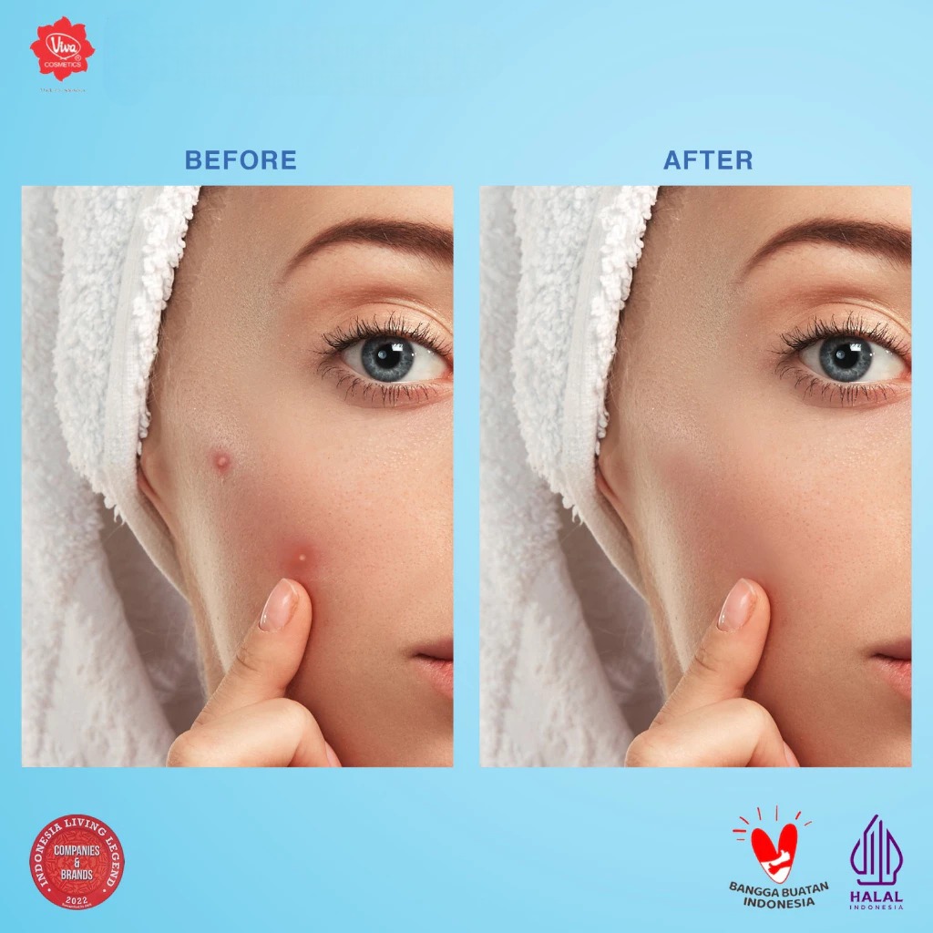 VIVA Acne Gel 15gr