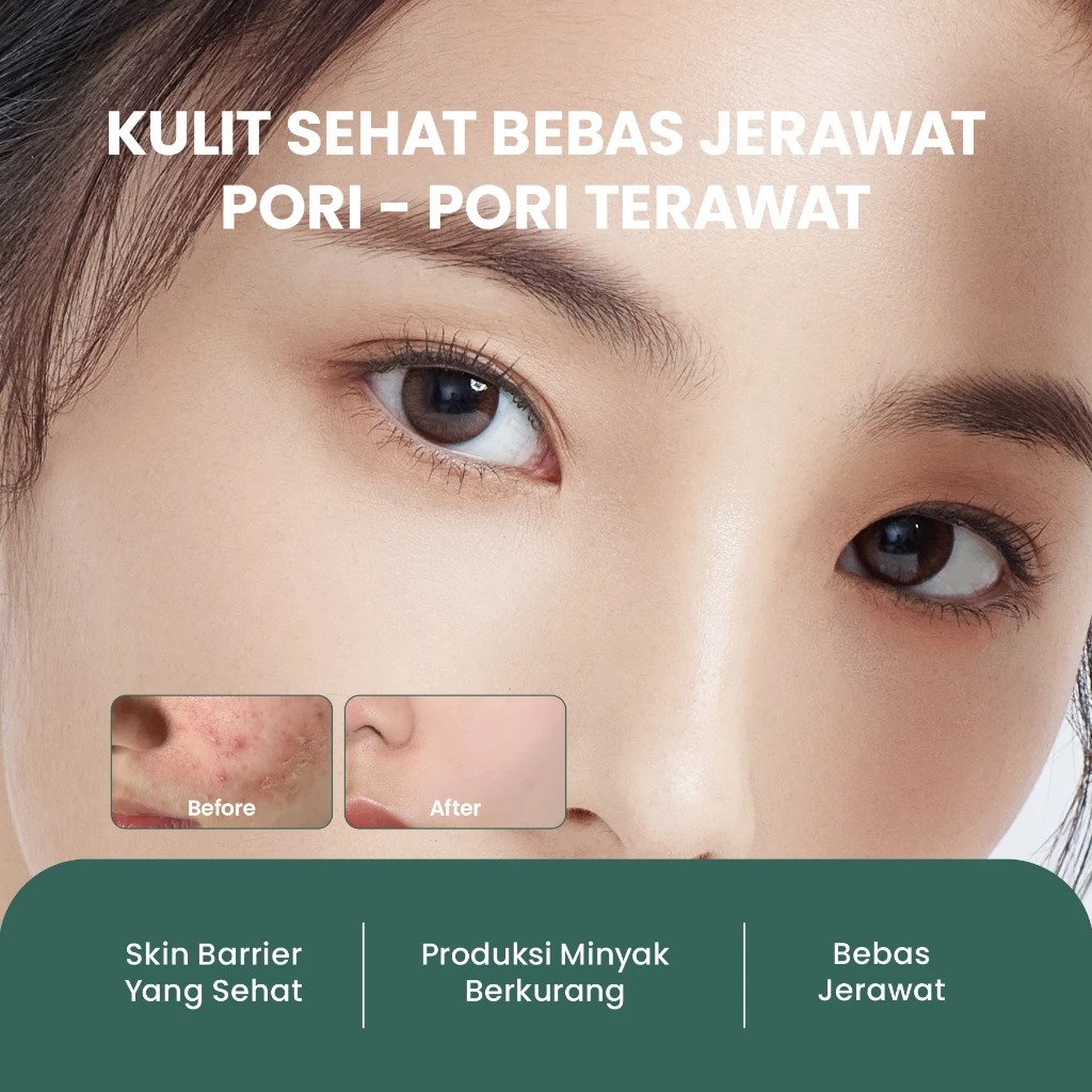 YOU Acneplus Fine Pore Oil Control Serum 20ml