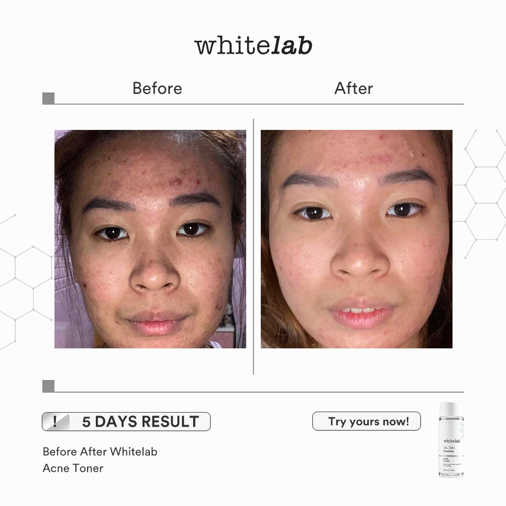 WHITELAB Acne Toner 100ml WHITELAB Acne Toner 100ml