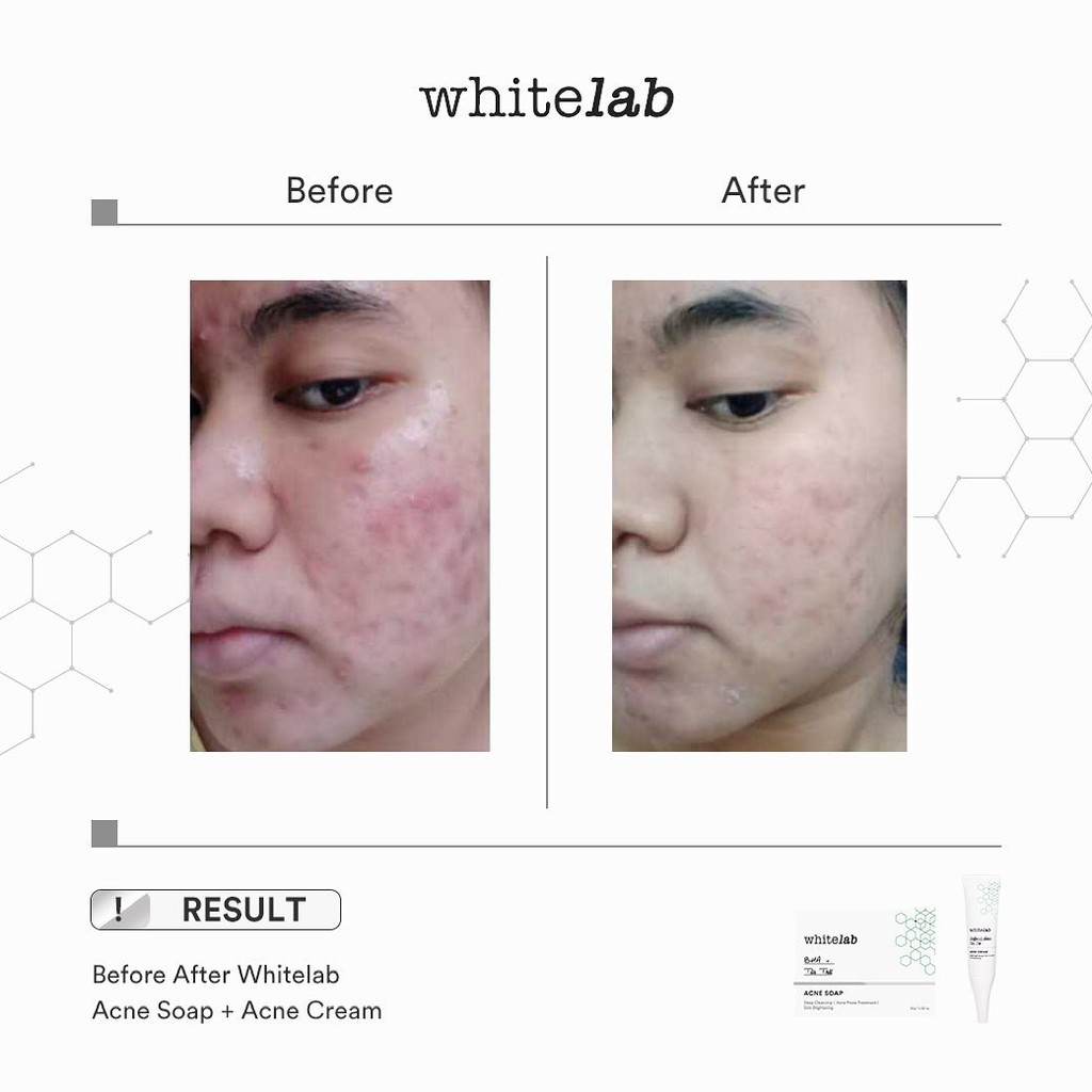 WHITELAB Acne Soap 80gr (Sabun Batang) WHITELAB Acne Soap 80gr (Sabun Batang)