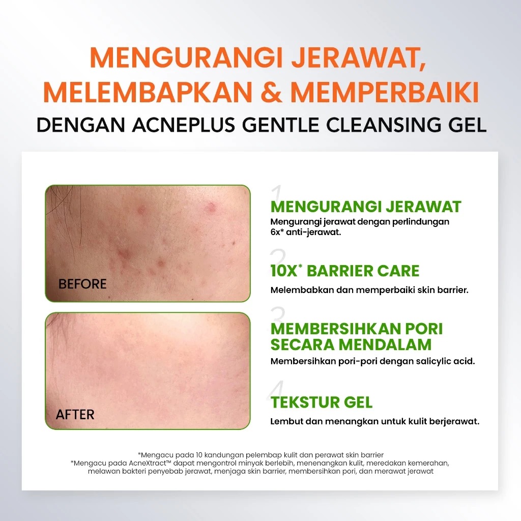 YOU Acneplus Gentle Cleansing Gel 100gr YOU Acneplus Gentle Cleansing Gel 100gr