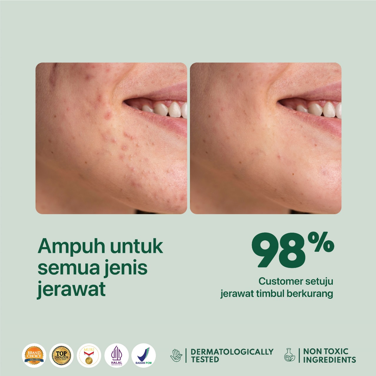 Npure Cica Acne Spot 20gr