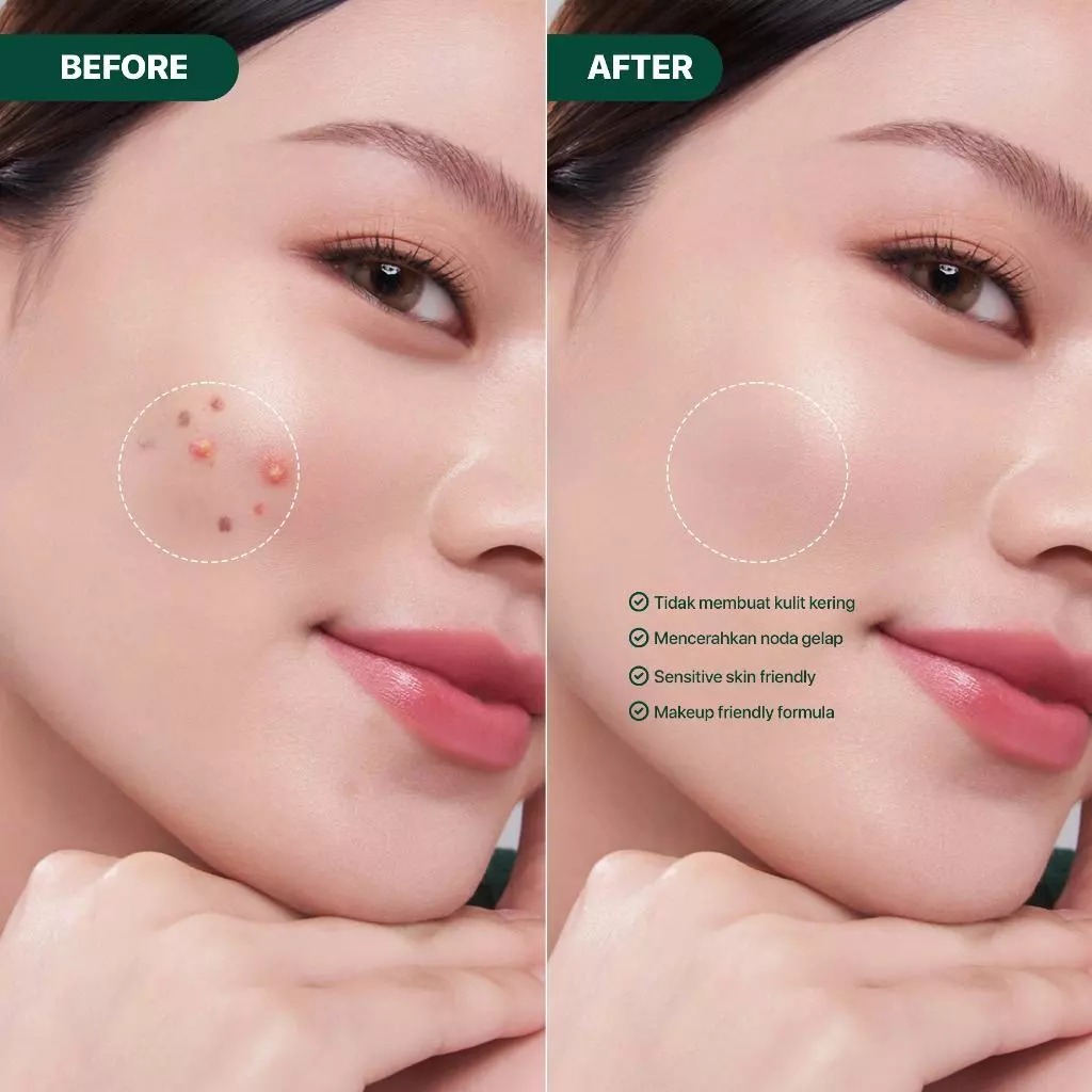 Npure Cica Acne Spot 20gr