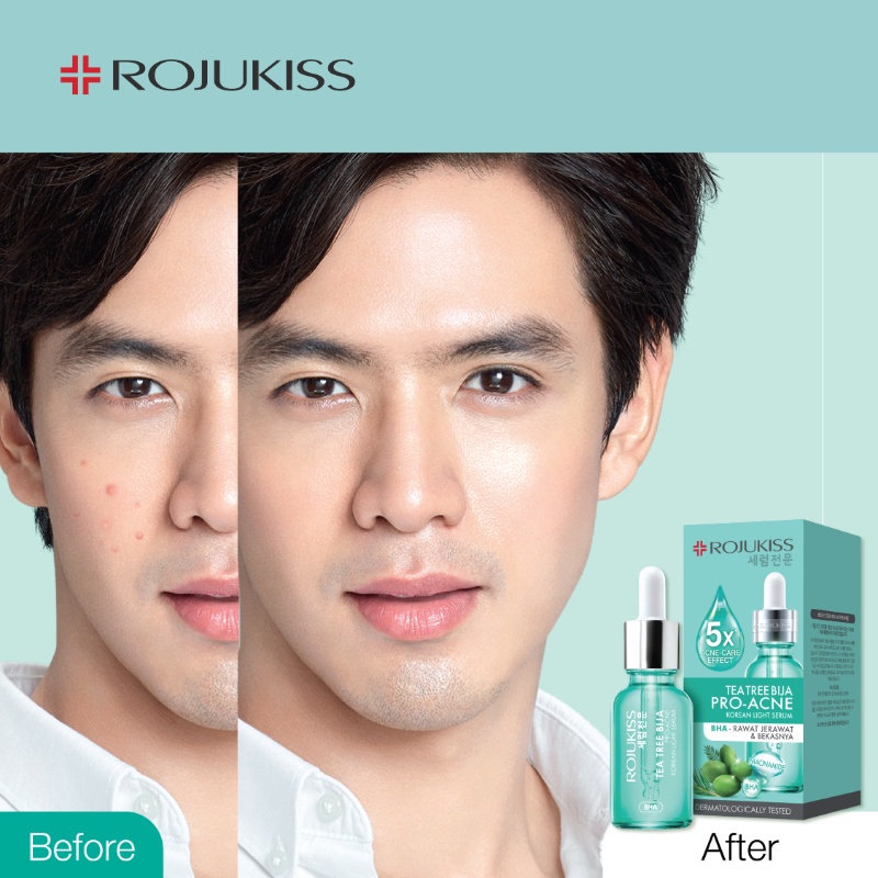 Rojukiss Korean Light Serum 30ml - Tea Tree Bija Pro Acne Serum