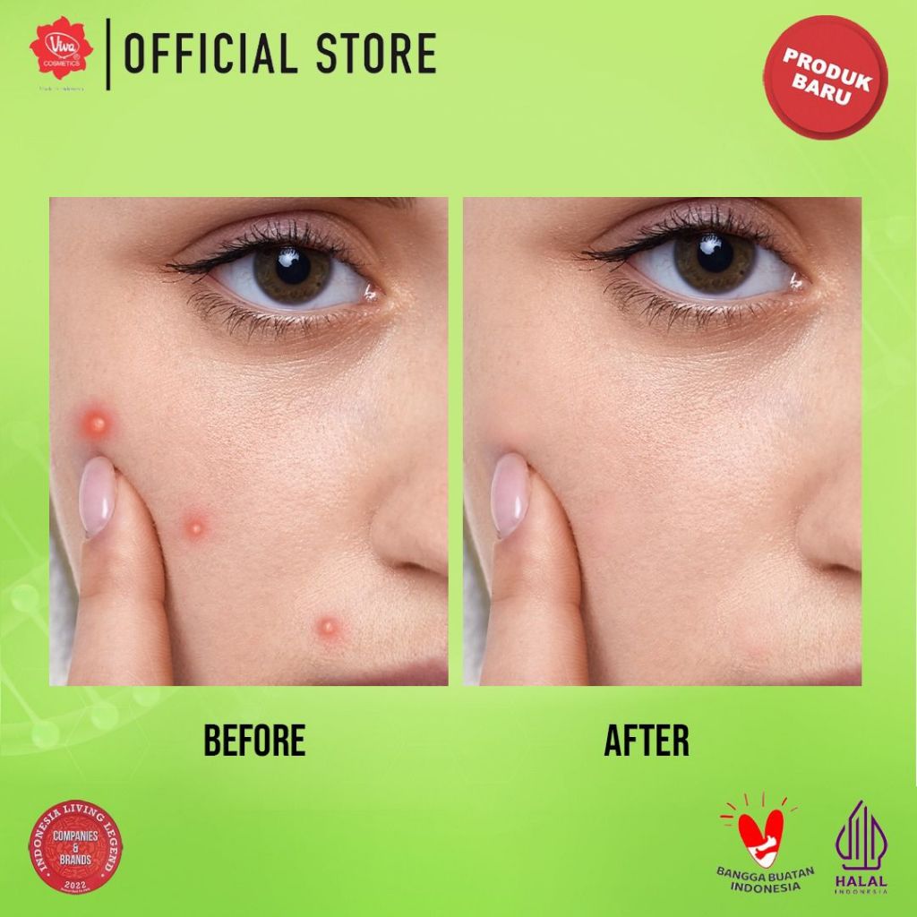 Viva Serum 20ml - Acne Serum