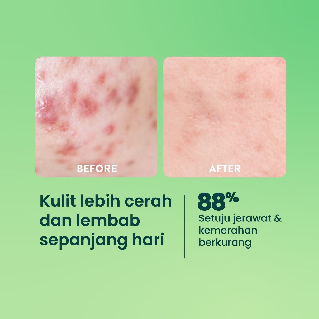 Npure Centella Asiatica Acne Clear Barrier Moisturizer 30gr