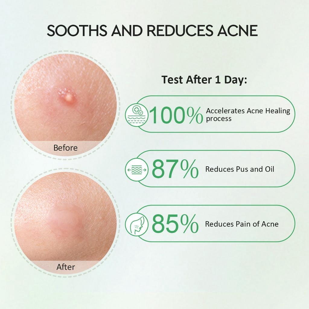 Glad 2 Glow Acne Patch - Centella Salicylic Acid Day 18patch