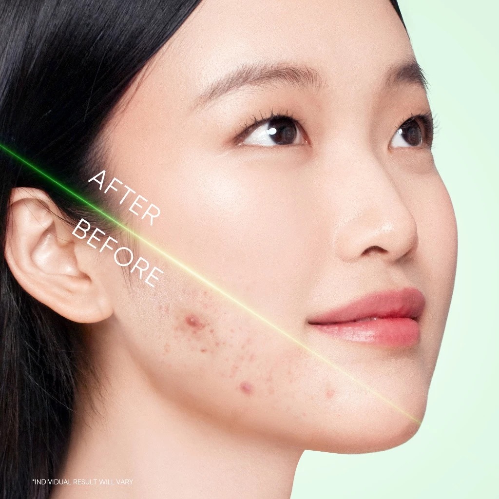 Skintific 3x Acid Acne Gel Cleanser 120ml