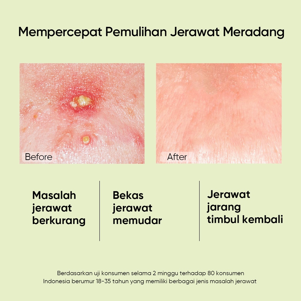 Skintific 2% Salicylic Acid Anti Acne Serum 50ml