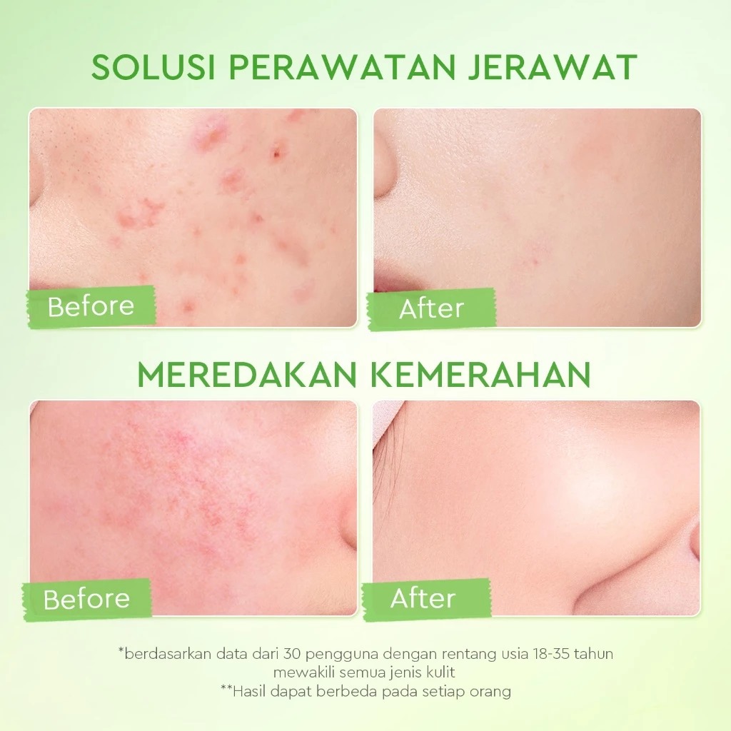 Glad 2 Glow Moisturizer - Kiwi 3D Acid Acne 100gr