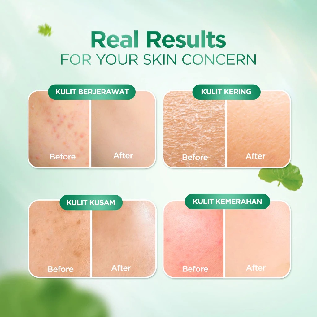 Acnaway Mugwort Water Gel 30gr