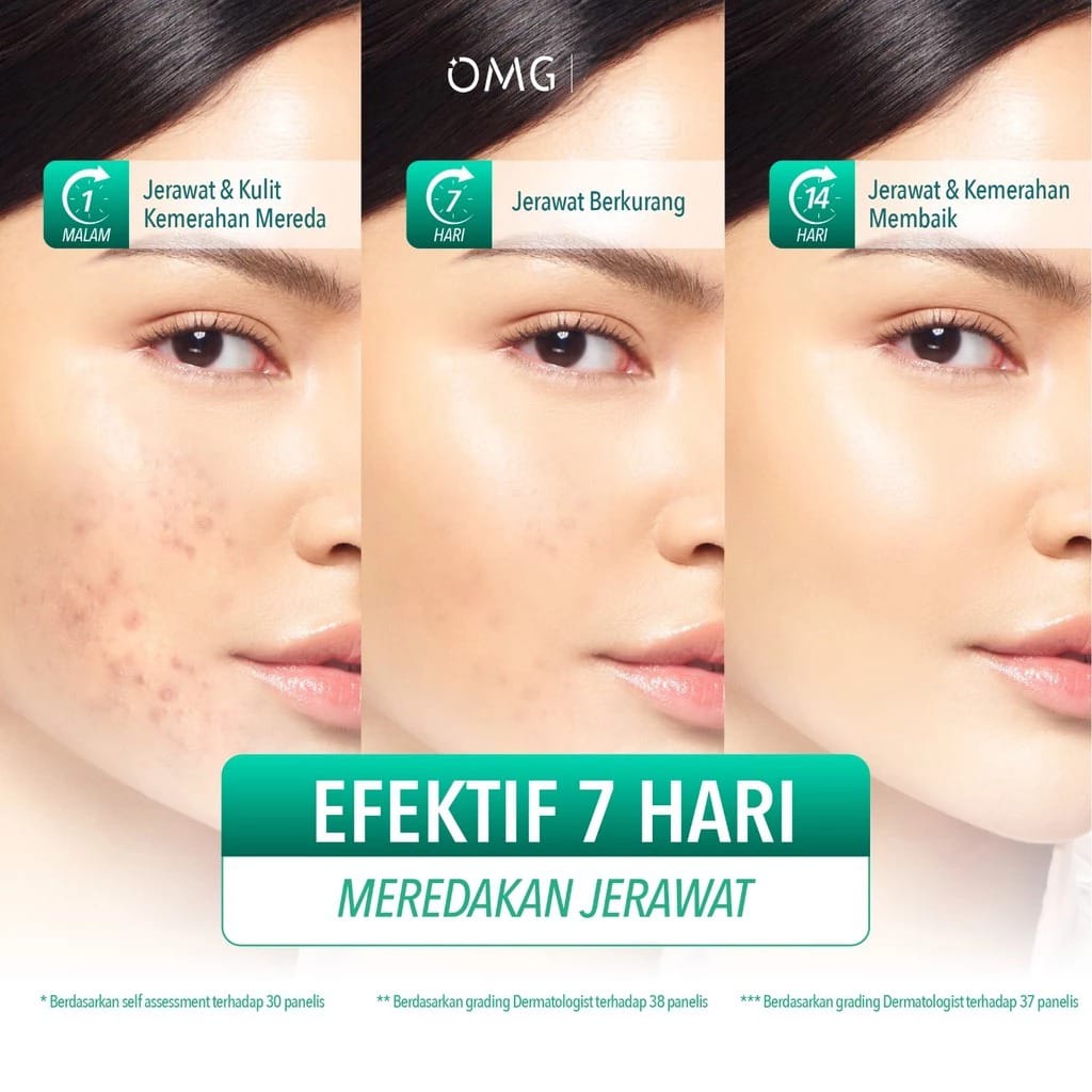 Oh My Glow Serum 17ml - 2% Salicylic Complex Acid Acne Intensive Solution Serum (OMG)