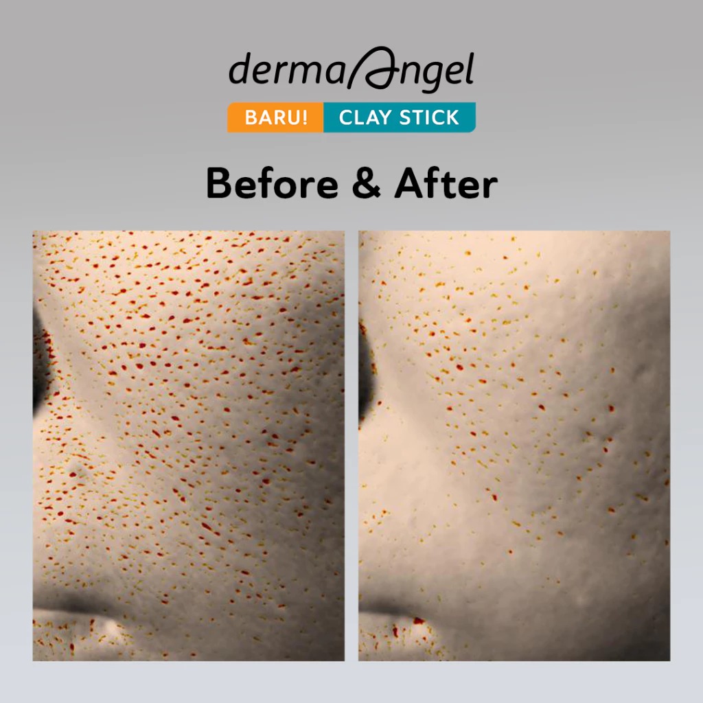 Derma Angel Acne Care Charcoal Pore Clear Clay Stick 20gr