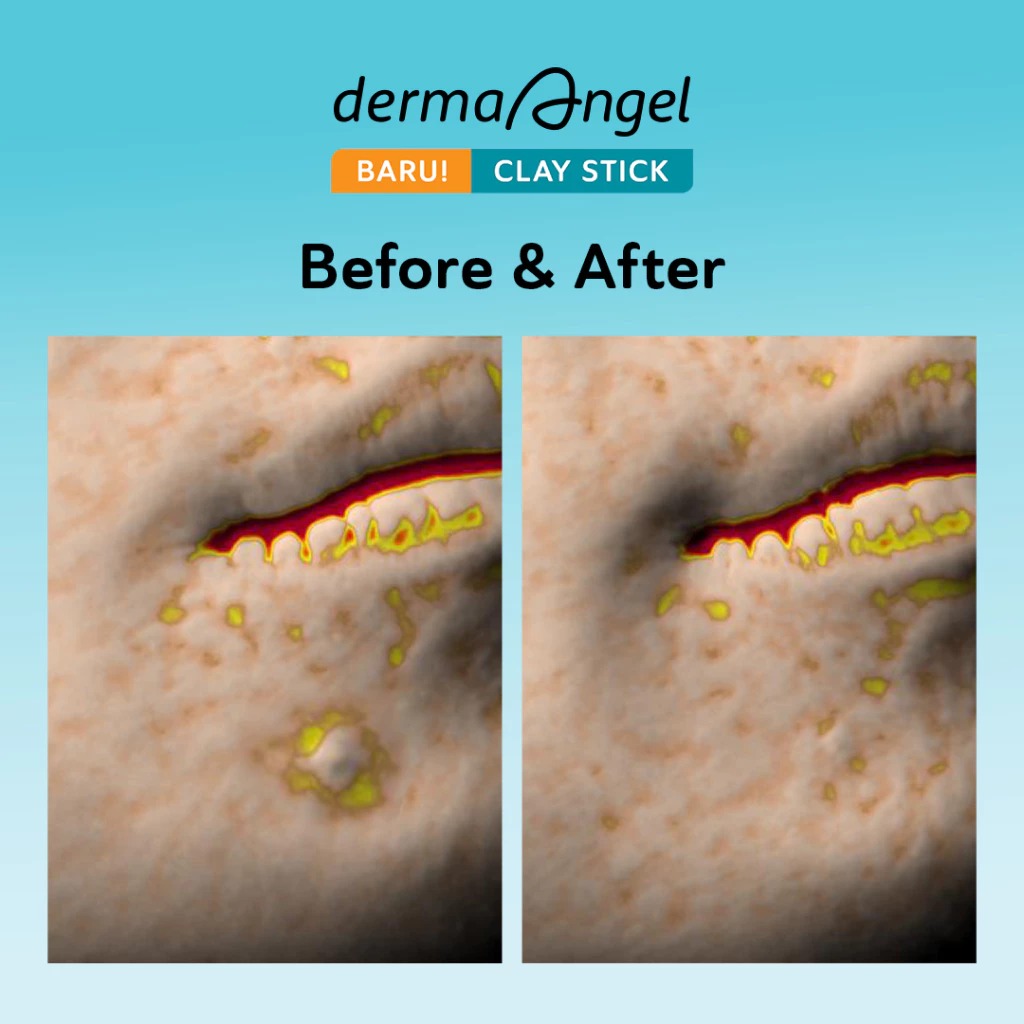 Derma Angel Acne Care Salicylic Acid Acne Clay Stick 20gr