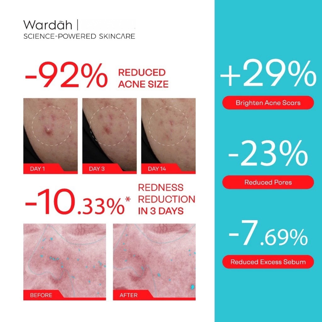 Wardah Acnederm Acne Relief Serum 20ml