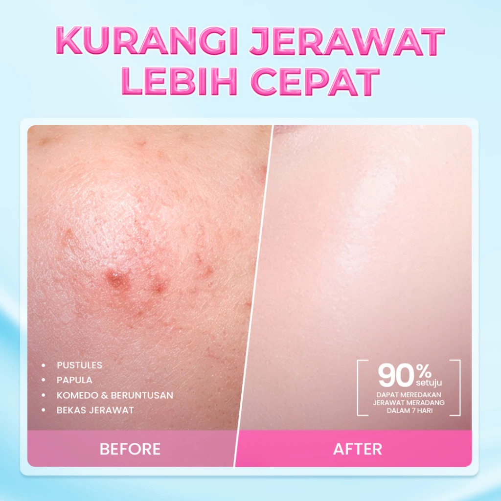 Hanasui Acne Care Moisturizer Gel 30gr