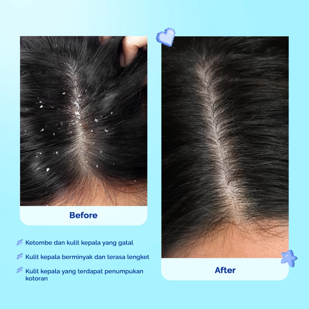 Hair Inc Dandruff Be Gone! Shampoo 130ml (Rambut Anti Ketombe)