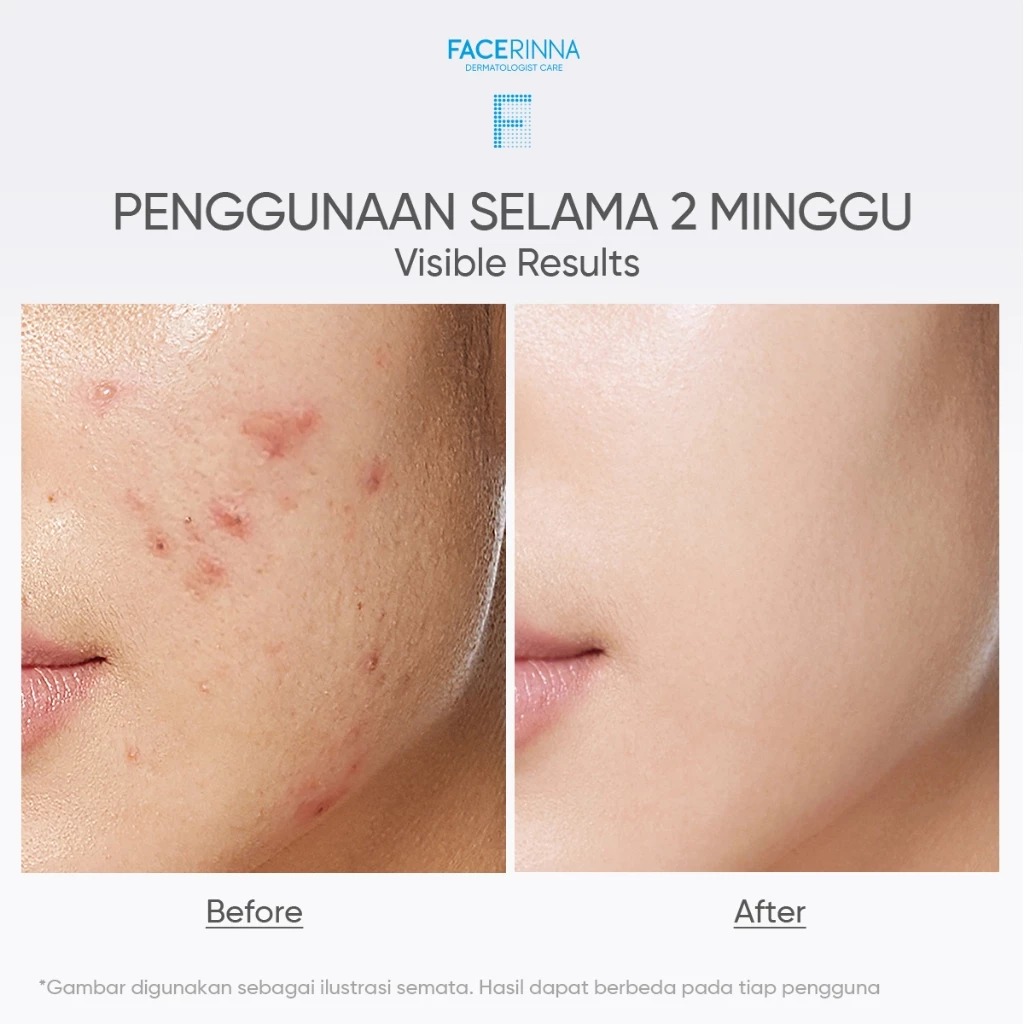 Facerinna Salicylic Acid Acne Gel Cleanser 120ml