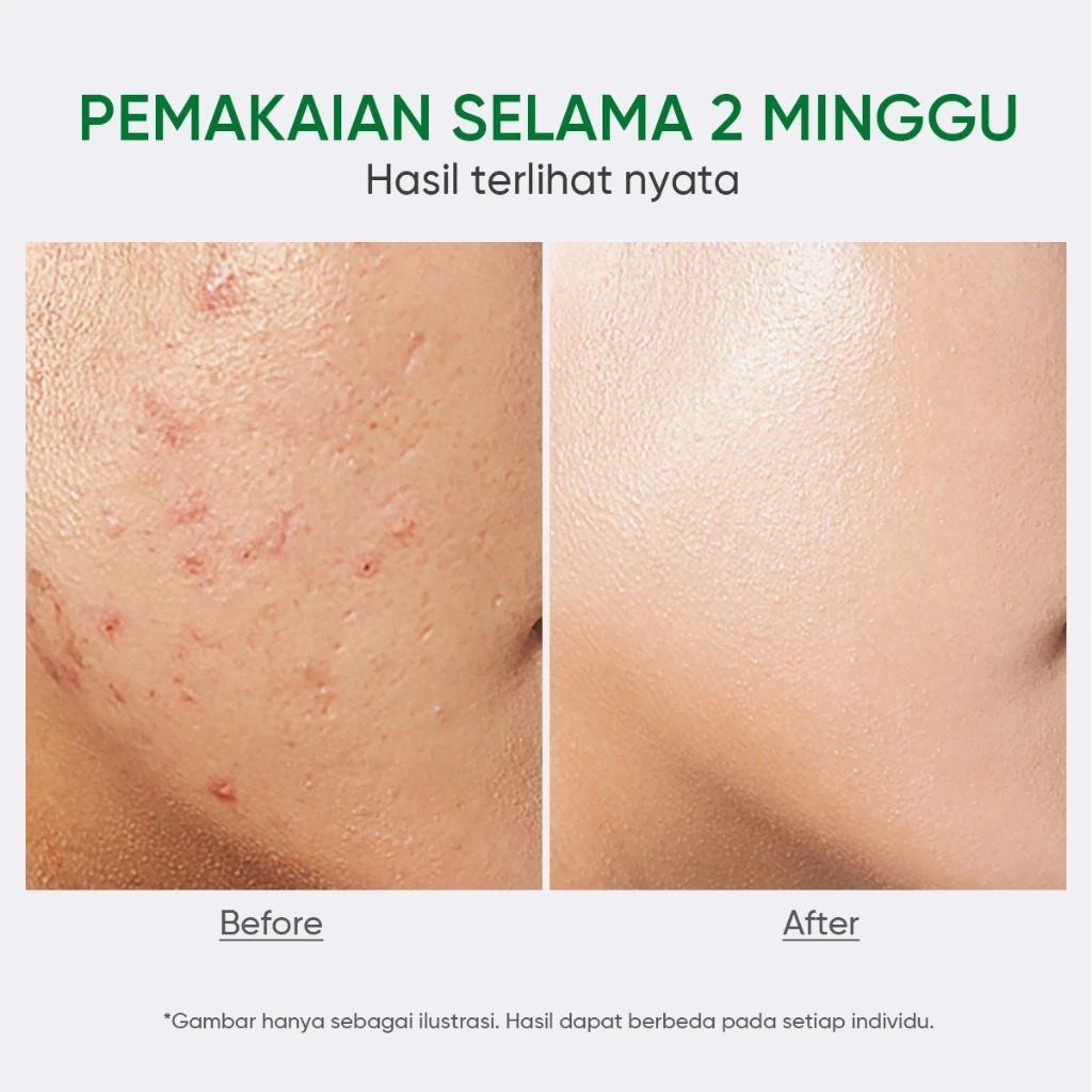 Facerinna 2% Salicylic Acid Acne Serum 20ml